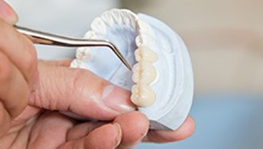 Model of teeth with implant supported crowns