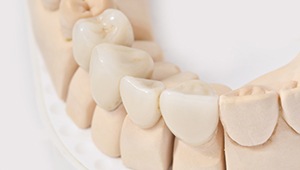 Model of dental implant tooth replacement