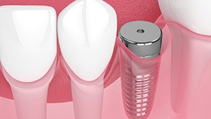 A single dental implant in Phoenix, AZ during osseointegration