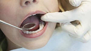 Closeup of child's smile after dental sealants