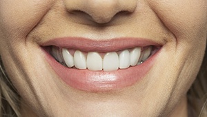 Closeup of smile following reconstruction