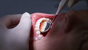 Closeup of smile examined after treatment