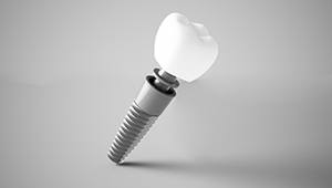 Closeup of a dental implant in Phoenix