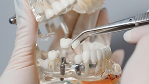 Phoenix implant dentist placing implant bridge on model jaw