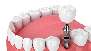 Digital illustration of a single tooth dental implant in Phoenix