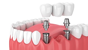 Digital illustration of implant bridge in Phoenix replacing several missing teeth