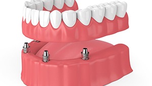 Digital diagram of an implant denture in Phoenix 