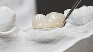 Model of smile with dental onlay