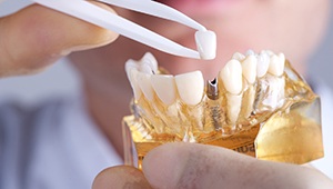 Model of implant supported dental crown