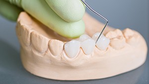 Model of smile with fixed bridge restoration