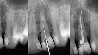 X-ray of root canals