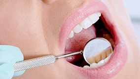 Closeup of teeth during dental exam