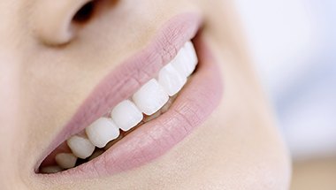 Closeup of flawless smile with porcelain veneers