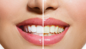 Closeup of someone’s smile that’s half stained on one side