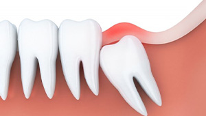 Illustration of an impacted wisdom tooth