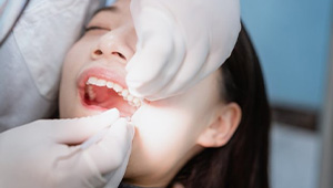 Dentist examining patients teeth before wisdom teeth extraction