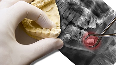 Wisdom teeth on x-rays