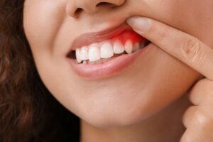 Woman showing red gums.