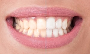 Some menu choices stain tooth enamel. Learn from the Glendale, AZ dentists at Smile Fitness Dental Center which foods and beverages cause discolorations.