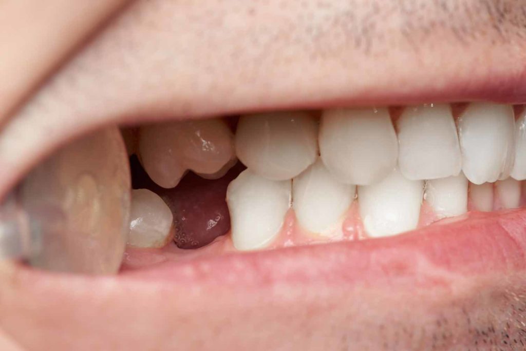 Up-close photo of someone who has had a tooth extraction from a dentist 