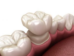 Illustration of a dental crown being placed.