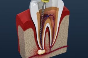 A cross section of a tooth getting a root canal