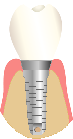 Implant3_edited